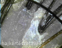 Korpásodás a fejbőrön korpás fejbőr