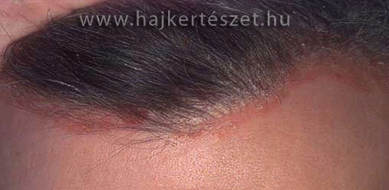 dandruff