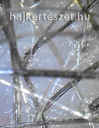 Ezen a képen már rengeteg, különböző életkorú hajszál látható. Újra sűrű haj. A haj kezelésének eredménye több új hajszál